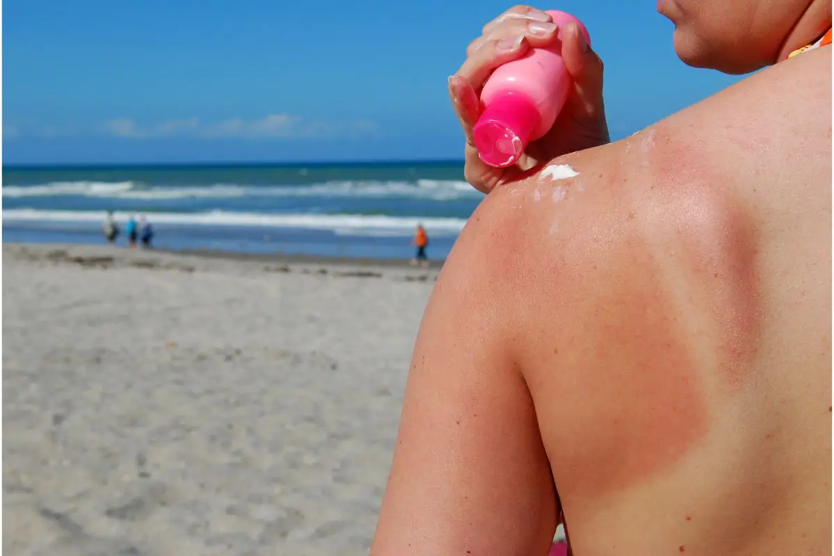 How To Treat Sunburn Blisters