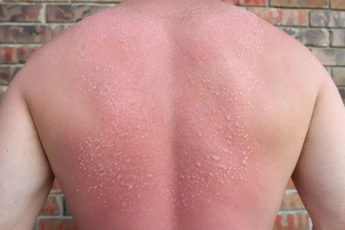 How To Treat Sunburn Blisters